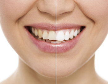 Teeth Whitening Fairfield County